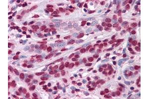Immunohistochemical analysis of paraffin-embedded human Breast tissues using anti-ZBTB7B mouse mAb (ZBTB7B anticorps)