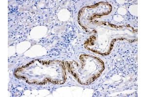 ACVR2A was detected in paraffin-embedded sections of human intestinal cancer tissues using rabbit anti- ACVR2A Antigen Affinity purified polyclonal antibody (Catalog # ) at 1 µg/mL.