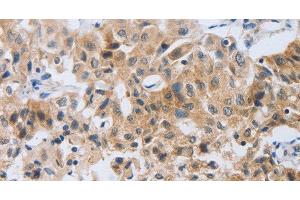 Immunohistochemistry of paraffin-embedded Human lung cancer tissue using NEB Polyclonal Antibody at dilution 1:80 (Nebulin anticorps)