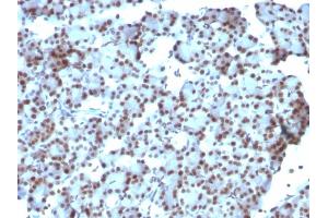 Formalin-fixed, paraffin-embedded human Ovarian Carcinoma stained with SUMO-1 Monoclonal Antibody (SUMO1/1188) (SUMO1 anticorps)