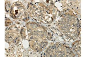 The image on the left is immunohistochemistry of paraffin-embedded Human breast cancer tissue using ABIN7128017(SIAH1 Antibody) at dilution 1/35, on the right is treated with fusion protein. (SIAH1 anticorps)
