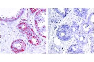 P-Peptide - +Immunohistochemical analysis of paraffin-embedded human breast carcinoma tissue using c-Jun (phospho-Ser243) antibody. (C-JUN anticorps  (pSer243))