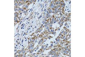 Immunohistochemistry of paraffin-embedded human lung cancer using ATP5B antibody.