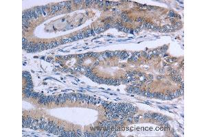 Immunohistochemistry of Human colon cancer using SLC1A6 Polyclonal Antibody at dilution of 1:40 (SLC1A6 anticorps)
