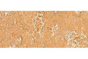 Immunohistochemistry of paraffin-embedded Human breast cancer tissue using KRT76 Polyclonal Antibody at dilution of 1:50(x200)