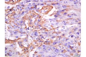 Paraformaldehyde-fixed, paraffin embedded human lung carcinoma tissue, Antigen retrieval by boiling in sodium citrate buffer(pH6) for 15min, Block endogenous peroxidase by 3% hydrogen peroxide for 30 minutes, Blocking buffer (normal goat serum) at 37°C for 20min, Antibody incubation with Rabbit Anti-Exportin-2 Polyclonal Antibody, Unconjugated  at 1:200 overnight at 4°C, followed by a conjugated secondary and DAB staining