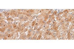 Immunohistochemistry of paraffin-embedded Human liver cancer tissue using GPC4 Polyclonal Antibody at dilution of 1:30(x200) (GPC4 anticorps)