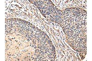 The image on the left is immunohistochemistry of paraffin-embedded Human esophagus cancer tissue using ABIN7128083(VIP Antibody) at dilution 1/20, on the right is treated with fusion protein. (Vip anticorps)