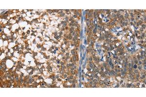 Immunohistochemistry of paraffin-embedded Human cervical cancer using MAD2L1BP Polyclonal Antibody at dilution of 1:65