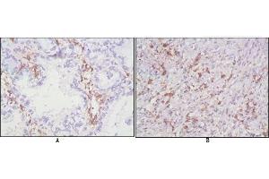 Immunohistochemical analysis of paraffin-embedded human lung cancer (A), lymphonodus tissue (B),showing cytomembrane localization using CD38 antibody with DAB staining. (CD38 anticorps)
