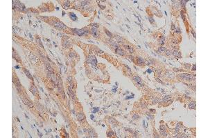 ABIN6267517 at 1/50 staining human lung cancer tissue sections by IHC-P. (MTOR anticorps  (pSer2448))