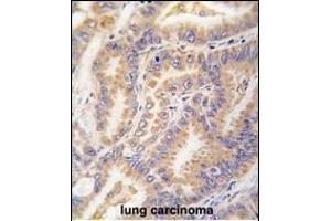 Formalin-fixed and paraffin-embedded human lung carcinoma tissue reacted with Autophagy G12L antibody (N-term) 1816a , which was peroxidase-conjugated to the secondary antibody, followed by DAB staining. (ATG12 anticorps  (N-Term))