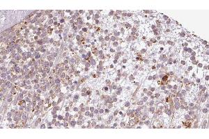ABIN6273199 at 1/100 staining Human lymph cancer tissue by IHC-P. (BAMBI anticorps  (Internal Region))