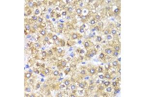 Immunohistochemistry of paraffin-embedded human liver cancer using SHMT2 antibody at dilution of 1:100 (400x lens). (SHMT2 anticorps)