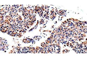 Immunohistochemistry of paraffin-embedded Human lung cancer using AKR1B1 Polyclonal Antibody at dilution of 1:40 (AKR1B1 anticorps)