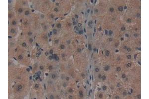 Detection of NOG in Human Liver cancer Tissue using Monoclonal Antibody to Noggin (NOG)