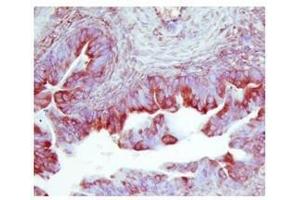TIMP2 in human ovarian cancer was detected using HRP/AEC red color stain (TIMP2 anticorps  (Middle Region))