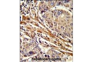 Formalin-fixed and paraffin-embedded human hepatocarcinoma reacted with RT Antibody (C-term), which was peroxidase-conjugated to the secondary antibody, followed by DAB staining. (APRT anticorps  (C-Term))
