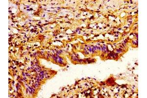 IHC image of ABIN7168784 diluted at 1:300 and staining in paraffin-embedded human lung cancer performed on a Leica BondTM system.
