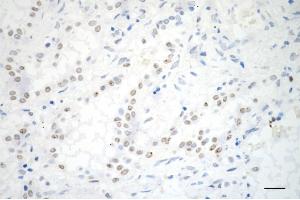 Immunohistochemistry was performed on paraffin-embedded human lung adenocarcinoma using ADAM17 antibody (ABIN7797502), 1:200). (Recombinant ADAM17 anticorps)