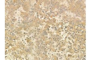 ABIN6260454 and ABIN6272856 at 1/100 staining human melanoma by IHC-P. (Caprin-1 anticorps  (Internal Region))