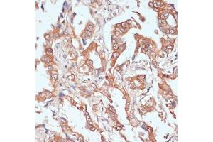 Immunohistochemistry of paraffin-embedded human lung cancer using PTPRN2 antibody (ABIN7269710) at dilution of 1:100 (40x lens).