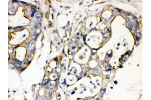 Anti- Plectin Picoband antibody, IHC(P) IHC(P): Human Intestinal Cancer Tissue