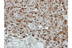 IHC-P Image Immunohistochemical analysis of paraffin-embedded MDAMB468 xenograft, using CRABP2, antibody at 1:500 dilution.