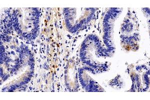 Detection of GCSFR in Human Colorectal cancer Tissue using Polyclonal Antibody to Colony Stimulating Factor Receptor, Granulocyte (GCSFR)