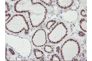 Immunohistochemical staining of paraffin-embedded Carcinoma of Human thyroid tissue using anti-GOLM1 mouse monoclonal antibody. (GOLM1 anticorps)
