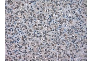 Immunohistochemical staining of paraffin-embedded Carcinoma of kidney tissue using anti-NAT8mouse monoclonal antibody. (NAT8 anticorps)