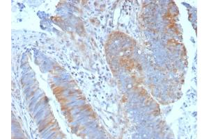 Formalin-fixed, paraffin-embedded human Colon Carcinoma stained with Calpain 1 Mouse Monoclonal Antibody (CAPN1/1530).