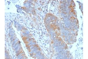 Formalin-fixed, paraffin-embedded human Colon Carcinoma stained with Calpain 1 Mouse Monoclonal Antibody (CAPN1/1530). (CAPNL1 anticorps)