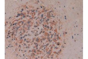 IHC-P analysis of Human Lung cancer Tissue, with DAB staining. (CD8B anticorps  (AA 22-170))