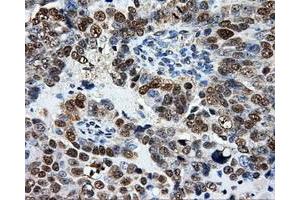 Immunohistochemical staining of paraffin-embedded Adenocarcinoma of breast tissue using anti-ATP5B mouse monoclonal antibody. (ATP5B anticorps)