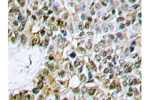 Immunohistochemistry analyzes of Caspase 9 antibody in paraffin-embedded human lung carcinoma tissue. (Caspase 9 anticorps)