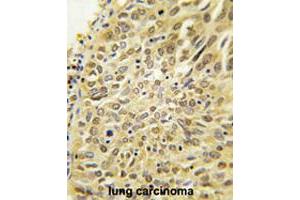 Formalin-fixed and paraffin-embedded human lung carcinoma tissue reacted with UBQLN2 polyclonal antibody  , which was peroxidase-conjugated to the secondary antibody, followed by DAB staining. (Ubiquilin 2 anticorps  (N-Term))