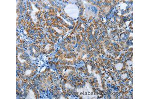 Immunohistochemistry of Human thyroid cancer using AGL Polyclonal Antibody at dilution of 1:30 (AGL anticorps)