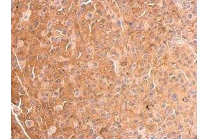 IHC-P Image Cofilin 1 antibody detects CFL1 protein at cytosol on HBL435 xenograft by immunohistochemical analysis. (Cofilin anticorps)
