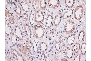 Immunohistochemical staining of paraffin-embedded Carcinoma of lung using anti-Stat4 (ABIN2452527) mouse monoclonal antibody. (STAT4 anticorps  (AA 633-652))