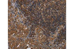 Immunohistochemistry of Human liver cancer using HOMER2 Polyclonal Antibody at dilution of 1:40 (HOMER2 anticorps)
