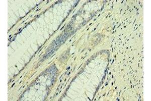 Immunohistochemistry of paraffin-embedded human colon cancer using ABIN7171560 at dilution of 1:100 (TAF1B anticorps  (AA 369-588))
