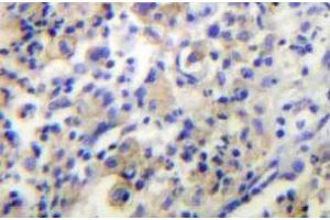 Immunohistochemistry (IHC) analyzes of TPH1 antibody in paraffin-embedded human lung carcinoma tissue. (Tryptophan Hydroxylase 1 anticorps)