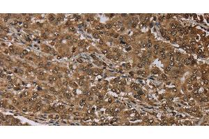 Immunohistochemistry of paraffin-embedded Human liver cancer tissue using MEIS1 Polyclonal Antibody at dilution 1:30 (MEIS1 anticorps)