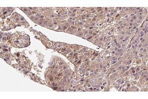 ABIN6279838 at 1/100 staining Human liver cancer tissue by IHC-P. (SLC4A7 anticorps  (Internal Region))