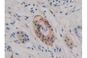 Detection of H2AFY in Human Pancreatic cancer Tissue using Polyclonal Antibody to H2A Histone Family, Member Y (H2AFY)