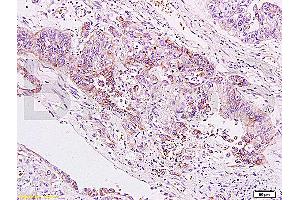 Formalin-fixed and paraffin embedded human gastric carcinoma labeled Anti-B7H4 Polyclonal Antibody, Unconjugated (ABIN671736) at 1:200, followed by conjugation to the secondary antibody and DAB staining (VTCN1 anticorps  (AA 50-100))