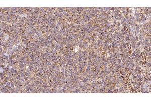 ABIN6273197 at 1/100 staining Human lymph cancer tissue by IHC-P.