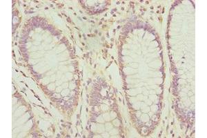 Immunohistochemistry of paraffin-embedded human colon cancer using ABIN7164691 at dilution of 1:100 (PDCD2L anticorps  (AA 1-358))