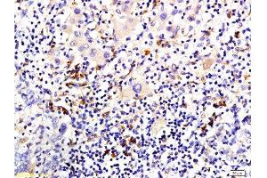 Formalin-fixed and paraffin embedded human liver carcinoma tissue labeled with Anti-P-CK/Cytokeratin AE1+AE3 Polyclonal Antibody, Unconjugated  at 1:200 followed by conjugation to the secondary antibody and DAB staining